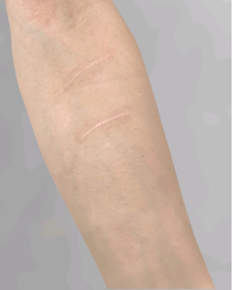 yahanzotattoo-tatuaż-blizny-coverupscars