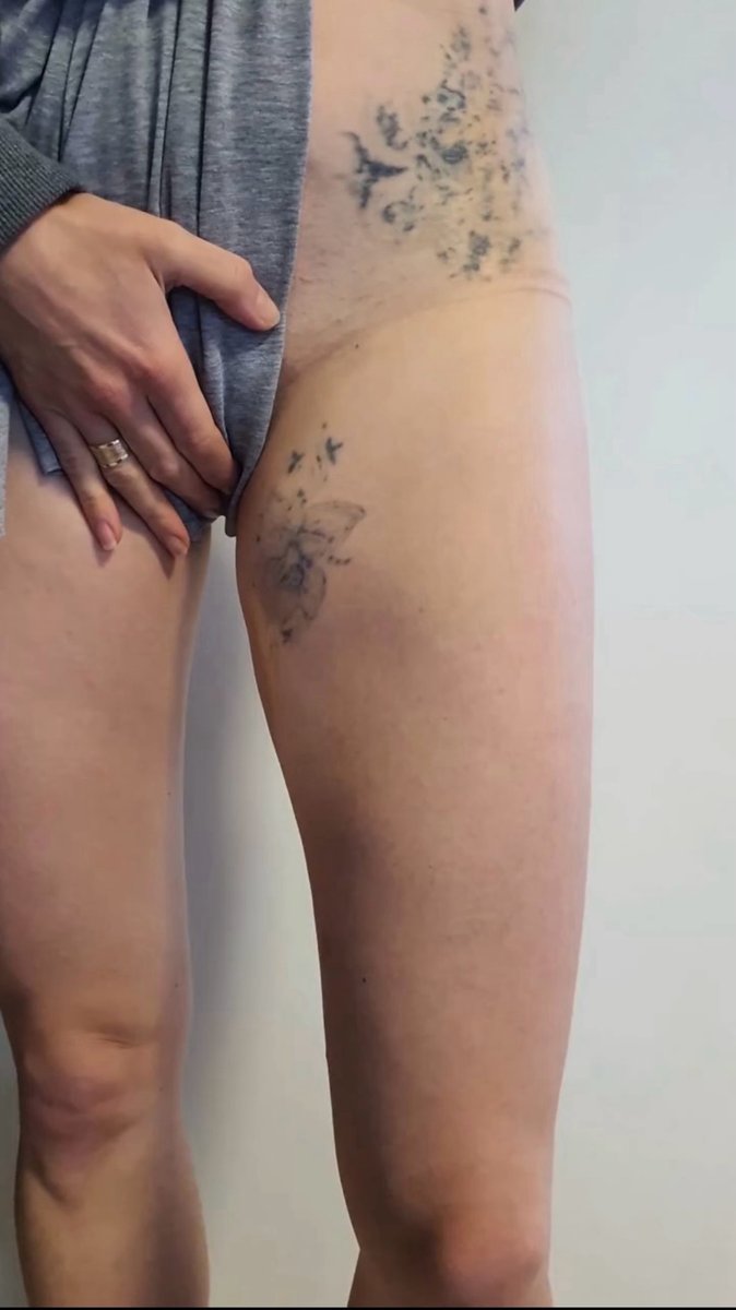 Jakub Malarz-tatuaż-cover-coverup-Black & Grey-Dotwork